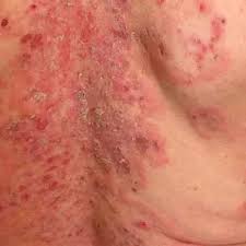 Image result for Pemphigus