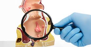 Image result for Anal Cancer