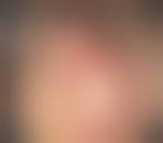 Image result for Rectal prolapse