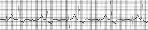 An electrocardiogram (ecg) may be done. Ecg Learning Center An Introduction To Clinical Electrocardiography