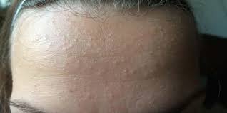 Tentu saja, adanya jerawat pasir ini dapat. Unleash Your Inner Glow Cara Menghilangkan Jerawat Pasir