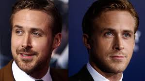 Beard transplants a growing trend