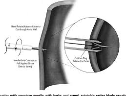 Figure 2 From The St Jude Medical Symmetry Aortic Connector