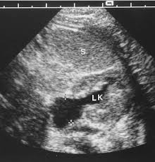 The Role Of Renal Ultrasound In Children With Febrile Urinary Tract Infection