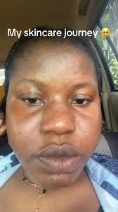 Stieva A Tretinoin Results