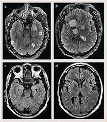 Image result for Brain Lesion