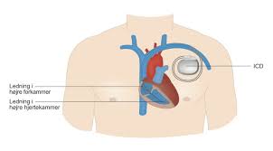Turn paced mode on the ecg; Defibrillator Icd Enhed Hjerteforeningen