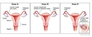 Many people with early ovarian cancer they are due to random changes (mutations) that occur only in the cells of the ovary. Ovarian Fallopian Tube Cancers Hematology Oncology Associates Of Cny