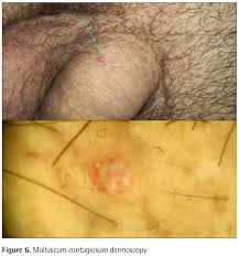Image result for genital warts