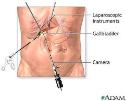 What To Expect From Gallbladder Surgery Gallbladder Surgery After Gallbladder Surgery Gallbladder