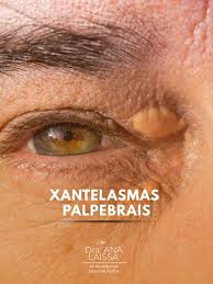 Image result for xantelasma