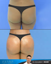 Pin On Bbl Brazilian Butt Lift Results