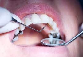 Beyond that question of how long does a cavity filling take, we all like to know what is happening while we sit in the dentist's chair. Should You Worry About Mercury In Your Silver Dental Fillings Health Essentials From Cleveland Clinic
