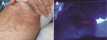 Image result for Erythrasma