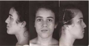 Atrofia hemifacial progressiva (Síndrome de Parry-Romberg): análise de 12  anos de tratamento no Instituto Ivo Pitanguy « Boletim de Cirurgia Plástica