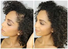 Regular tensile stress can lead to serious hair loss conditions, such as traction alopecia, which can be caused by wearing tight hairstyles for a long period of time. 2 Easy Hacks For Hiding Your Traction Alopecia Naturallycurly Com