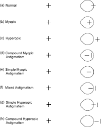 Treatment Of Astigmatism Related Amblyopia In 3 To 5 Year Old Children Sciencedirect