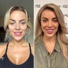 eilishflesch neuscorrectie bij Esteworld beste keus ooit!