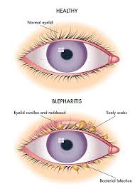 How To Manage Anterior Blepharitis Have You Ever Experienced Having Your Eyelids Stuck Together How About Having Itchy And Blepharitis Itchy Eyelids Dry Eyes