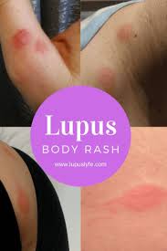 Most thyroid cancers are found at an early stage and can be treated successfully. Lupus Body Rash Lupus Lyfe Body Rash Lupus Facts Autoimmune Disease Symptoms