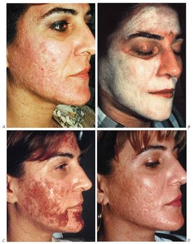 Peeling químico con ácido tricloroacético. Un peeling clásico de máxima actualidad | Actas Dermo-Sifiliográficas