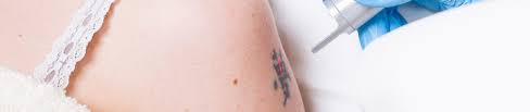 In order to erase a tattoo with hydrogen peroxide it is necessary to invest a lot of time, since it is necessary to reach that second layer and this can cause irritations and there is even risk of infection. How Much Time Will A Tattoo Take To Fade With Hydrogen Peroxide Blog Berry Fresh Blogging