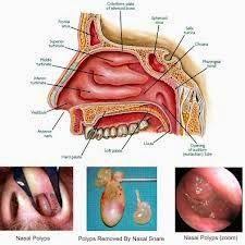 Pin On Obat Herbal Untuk Penyakit Polip Hidung