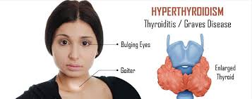 Exposure to high levels of doctors aren't sure what causes most cases of thyroid cancer, so there's no way to prevent thyroid cancer in people who have an average risk. Symptoms Of Thyroid Cancer In Females Forum Hypothyroid Drink Healthy Thyroid Thyroid Disease As My Husband And I Were Going Overseas For A Month I Had It Checked Out