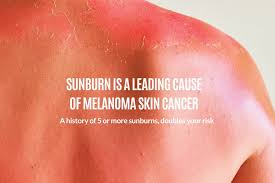 Image result for Sunburn