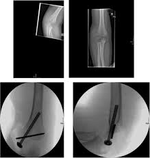 The rounded protuberance at the end of a bone which is most often part of a joint or an attachment with another bone is called condyle. Journal Of Medical And Psychological Trauma Open Access Pub