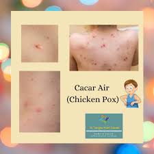 Varicella (disebut juga cacar air) adalah penyakit sangat menular yang disebabkan oleh virus. Ambilah Vaksin Cacar Air Chicken Pox Penting 2 Dos Untuk Bagi 98 Perlindungan Pada Anak Pa Ma