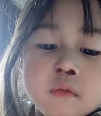 Ada dua tipe pendarahan pada hidung: Artis Malaysia Bila Anak Stacy Hidung Berdarah Shian Facebook