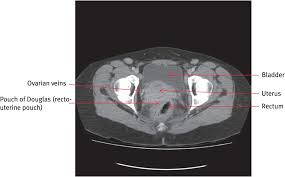 The labeled structures are (excluding the correct side): Applied Anatomy And Imaging Of The Bladder Ureter Urethra Anus And Perineum Chapter 3 Mrcog Part One