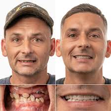 Full Mouth Implants in Jacksonville, FL