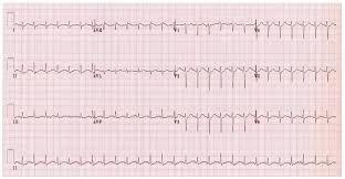 Many people who get myocarditis are otherwise. Myocarditis In The Ed Nuem Blog