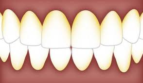 How to clean plaque off teeth with braces. How To Get Rid Off Tartar And Plaque Istanbul Dental Care
