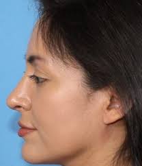 Plastic Surgery in NYC New York City Ira Savetsky MD