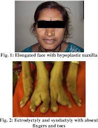 Figure 1 From Ectrodactyly Ectodermal Dysplasia Cleft Lip Palate Syndrome Report Of 3 Cases Semantic Scholar