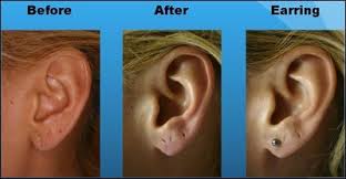 Update your find a dermatologist profile, the academy's directory that's visited by over 1 million people a year. Ear Lobe Tears Treatment Aventura Fl Cosmetic Therapist Aventura Fl