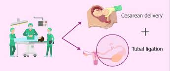 Tubal Ligation During C Section Csamedicalcentre Com
