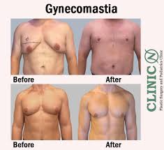 Image result for Gynecomastia