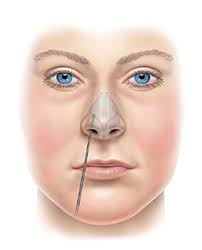 Older piercings are tough to open on your own. Nasal Airway Obstruction Ent Stryker