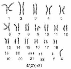 Down Syndrome Faq