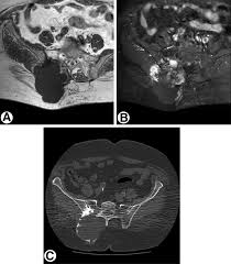 Image result for Chondrosarcoma