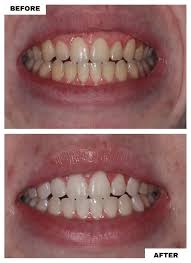 Image result for Teeth Whitening