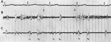 Image result for Venous Hum