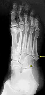 In children, avulsion fractures that involve the growth plates also might require surgery. Proximal Fifth Metatarsal Fractures Uptodate