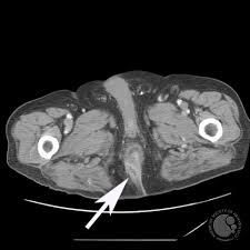 Image result for Perirectal Abscess