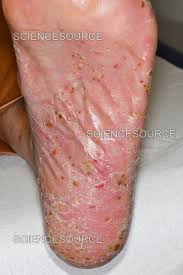 Image result for Pustular Psoriasis
