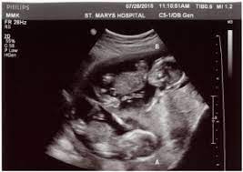 Did You Find Out It Was Twins At Later Ultrasound Twin Ultrasound Twiniversity